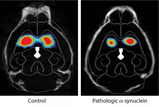 脑成像显示,胃肠道注射病理蛋白后,小鼠大脑内多巴胺系统受损(图片