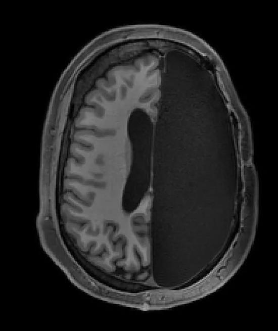 MRI扫描下成年人的半个大脑横截面 图源：www.livescience.com